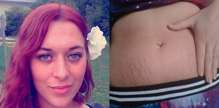 Nanay, nakadiskubre ng mabisang paraan para matanggal ang stretch marks