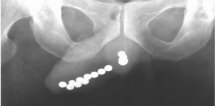 39 magnetic beads found in 12-year-old's penis