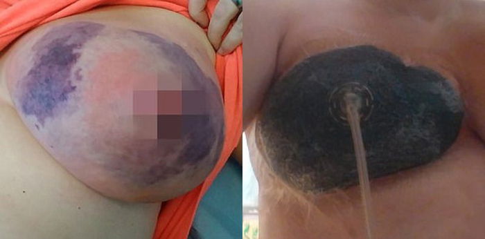 Nanay, nangitim ang suso at muntik nang mamatay dahil sa necrotizing mastitis