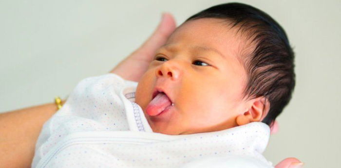 Baby na may Beckwith-Wiedemann Syndrome, kinailangang operahan