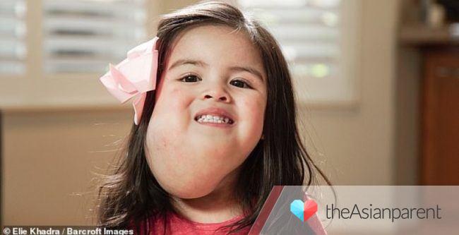 Bukol sa mukha ng isang batang babae inaasahang matatanggal ng Sclerotherapy!