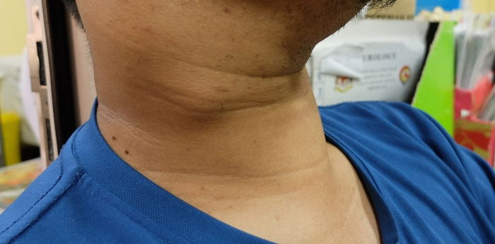 7 na sintomas ng kulani na dapat bantayan at gamot para rito