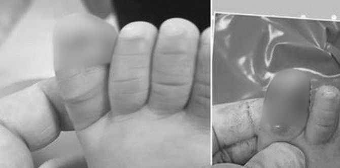 10-buwan baby nagkaroon ng necrosis sa paa matapos putulan ng kuko