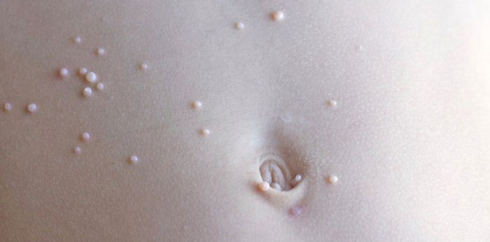 Molluscum contagiosum: Sanhi, sintomas, at lunas