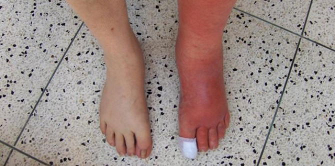 Cellulite at Cellulitis: Ang lahat ng dapat mong malaman tungkol rito