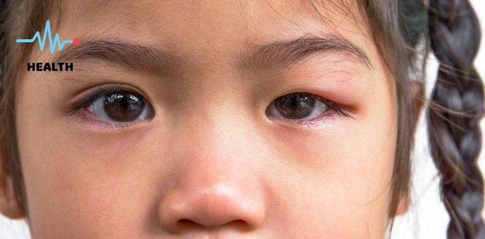 #AskDok: Ano ang gamot sa kuliti sa mata at paano ito maiiwasan?