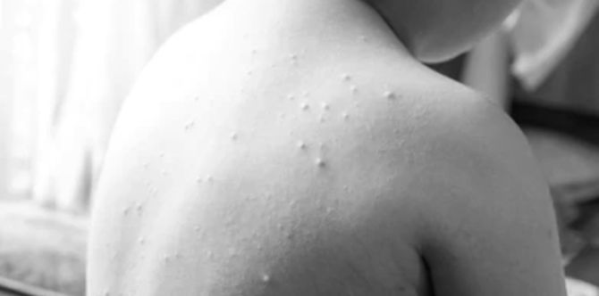 What is monkeypox: Everything you need to know about this rare disease