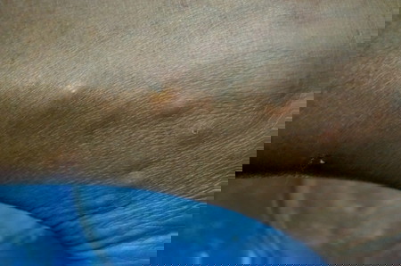 Kagat Ng Surot: Palatandaan Na Ikaw Ay Nakagat At Gamot Para Dito