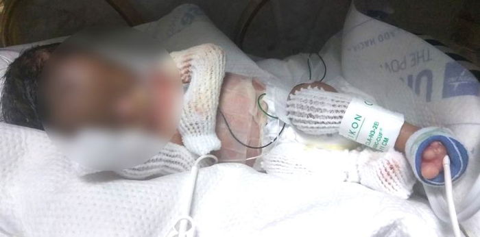 Baby, ipinanganak na walang balat ang ilang parte ng katawan