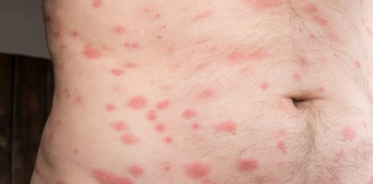 Mga Sakit at Kalusuang Panganib na Dulot ng Mga Peste sa Tahanan