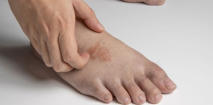 11 natural at mabisang gamot para sa buni o ringworm