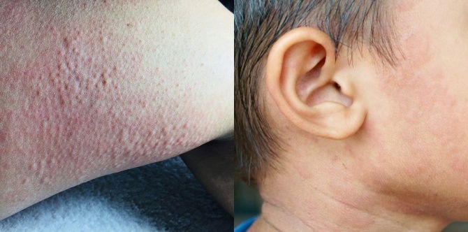 Cold urticaria: Sanhi, sintomas, at gamot para sa skin allergy dulot ng lamig