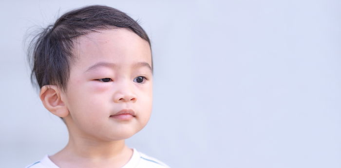 #AskDok: Ano ang dapat gawin kapag nakagat ng ipis ang bata?