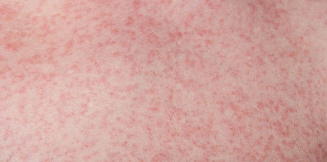 #AskDok: Ano ang pinagkaiba ng normal rash sa rash na dala ng dengue?