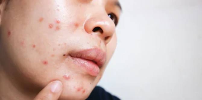 #AskDok: Paano maiiwasan magkaroon ng pimples?