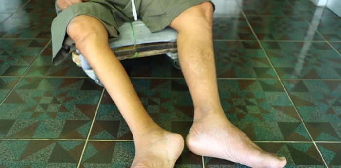 7 hinihinalang bagong kaso ng polio naitala sa bansa