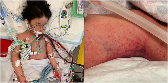 Mum's Horror As 4-Year-Old Son With Leg Pain Gets Diagnosed With Sepsis