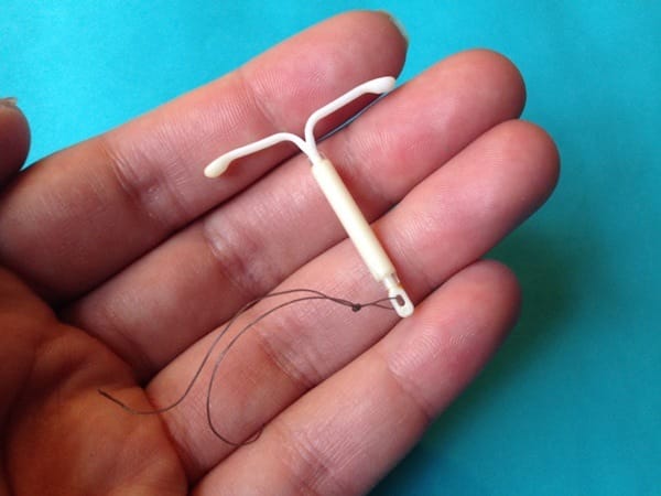 IUD ng nanay, nagmistulang hair pin sa buhok ng baby