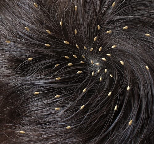 All About Head Lice