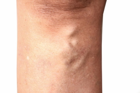 vulvar varicose veins