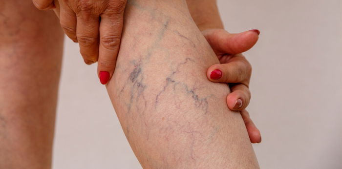 Vulvar varicosities: Varicose veins sa ari ng babae kapag buntis