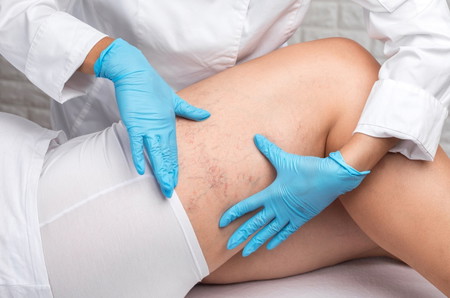 vulvar varicose veins