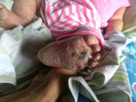 scalded skin syndrome