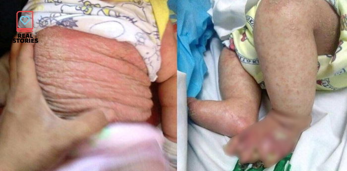 Baby kinailangan operahan dahil nabulok ang daliri sa paa