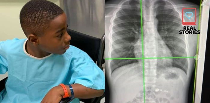 7-year-old na bata nakalunok ng airpods