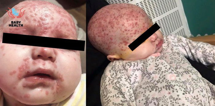 6 na buwang baby muntik mabulag ng magkaroon ng herpes dahil sa halik