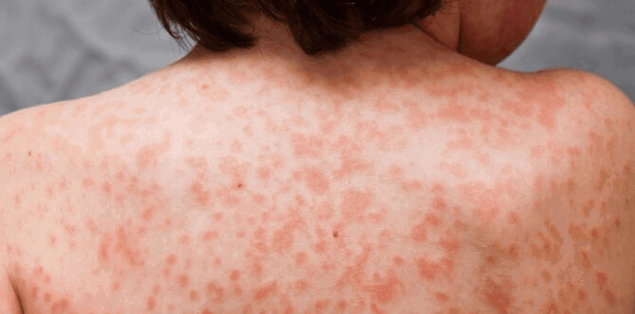 Sakit sa tiyan, Kawasaki disease at iba pang sakit na lumalabas sa mga batang may COVID-19