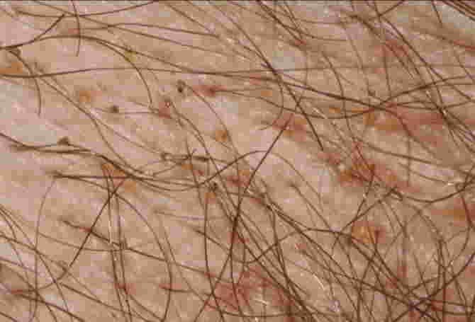 larawan ng ibat ibang uri ng sakit sa balat - skin lice infection