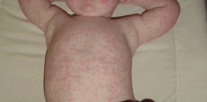 8 common skin rashes sa baby at bata tuwing mainit ang panahon