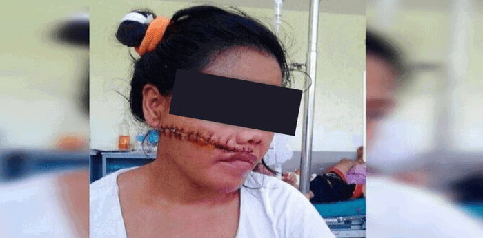 Babae tinaga sa mukha ng kaniyang mister sa Zamboanga