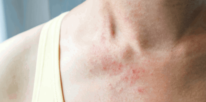 Skin rashes, bagong sintomas ng COVID-19 ayon sa pag-aaral