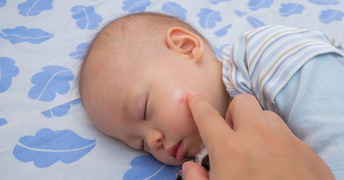 Useful ways to treat mosquito bites in babies