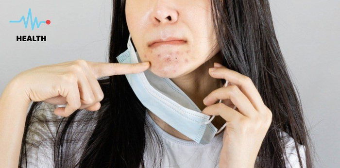 Dumadami ang pimples dahil sa face mask? 5 tips kung paano maiiwasan ito