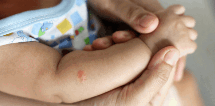 10 na mabisang gamot at home remedy sa kagat ng insekto na safe kay baby