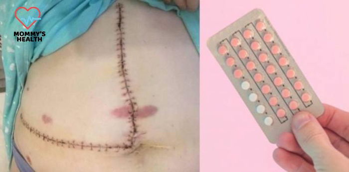 Babae nagkaroon ng tumor sa atay matapos ang 12 years na paggamit ng contraceptive pills