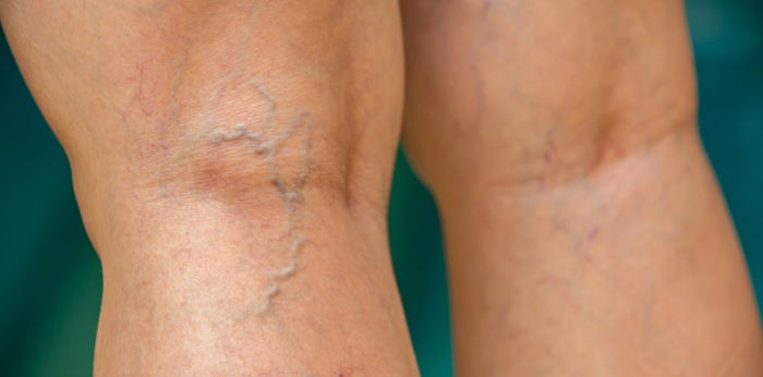 Ugat sa binti: Sanhi, sintomas at paraan para mawala ito