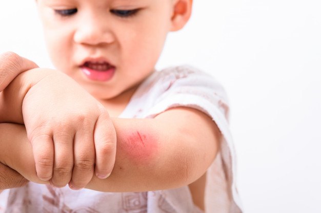 A Skin Irritation and Flare up Guide: Will Baby Lotion for Sensitive Skin Help?