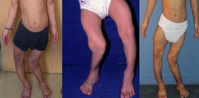 Maaaring ma-deform ang bones ng bata kapag kulang sa vitamin na ito