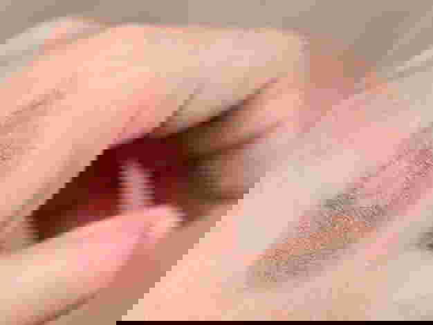 What is the medicine for a child who gets burned?