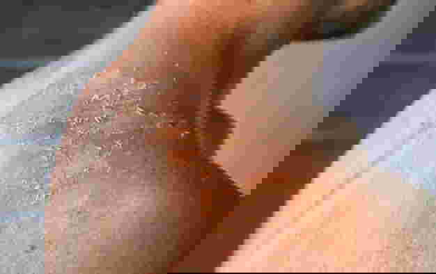 What is the medicine for a child who gets burned?