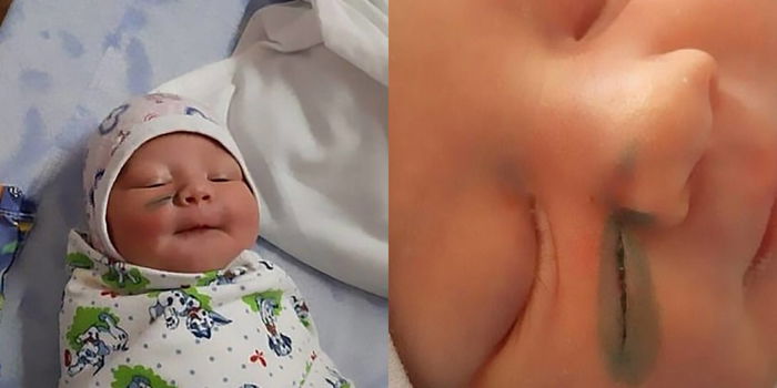 Baby girl, aksidenteng nahiwa ang mukha nang ipanganak via CS