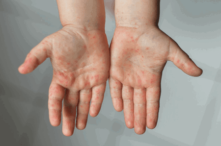 chicken pox in pregnancy