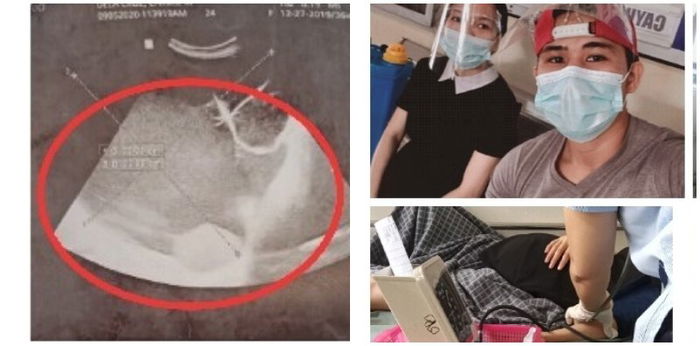 REAL STORIES: "Akala ko malaki lang ako magbuntis—may cyst na pala na tumubo sa ovary ko"