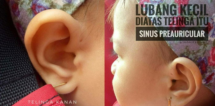 REAL STORIES: "May butas sa tainga ang anak ko—hindi daw pala dapat ito balewalain"