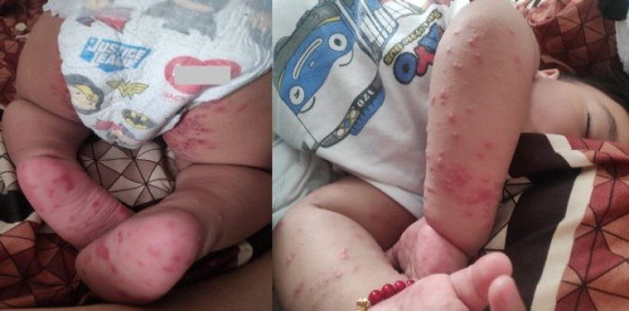 REAL STORIES: 1 year-old baby na minsang naglaro sa indoor playground, nahawa ng HFMD