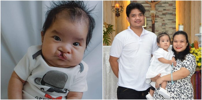 Mom ng baby na may cleft lip and palate: "Hindi ko halos matanggap. Sinisisi ko ang aking sarili sa nangyari sa kanya."
